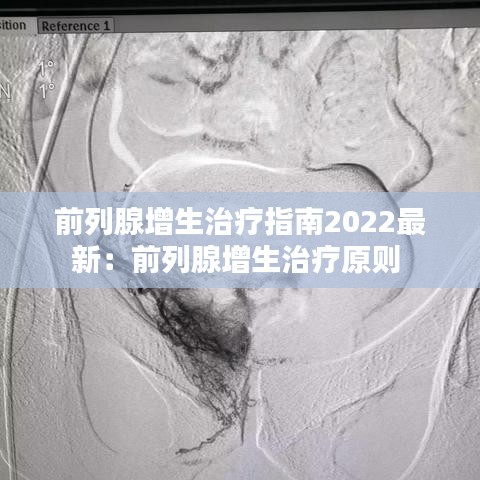 前列腺增生治療指南2022最新：前列腺增生治療原則 